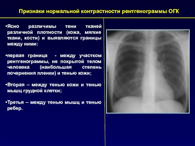 Ясно различимы тени тканей различной плотности (кожа, мягкие ткани, кости) и