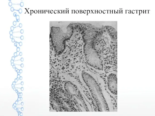 Хронический поверхностный гастрит