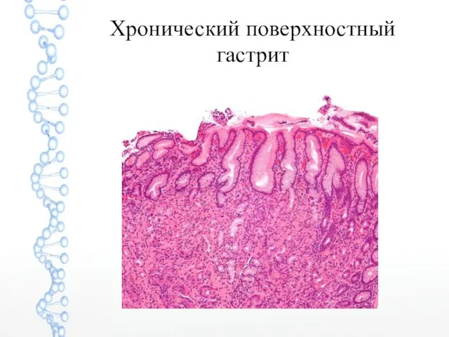 Хронический поверхностный гастрит