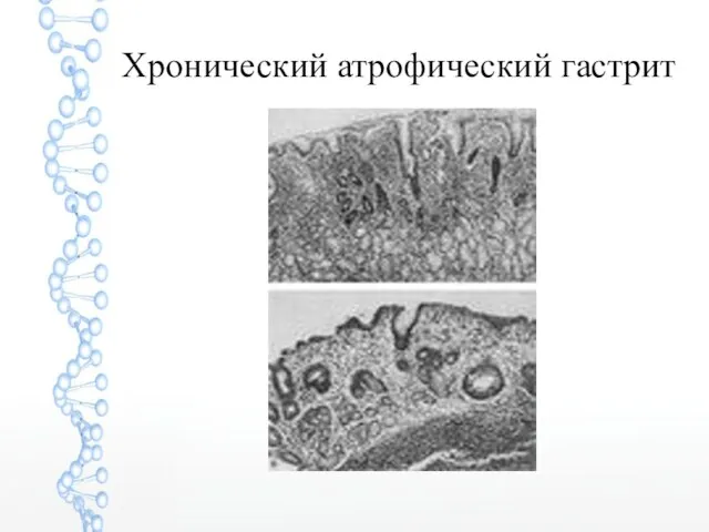 Хронический атрофический гастрит