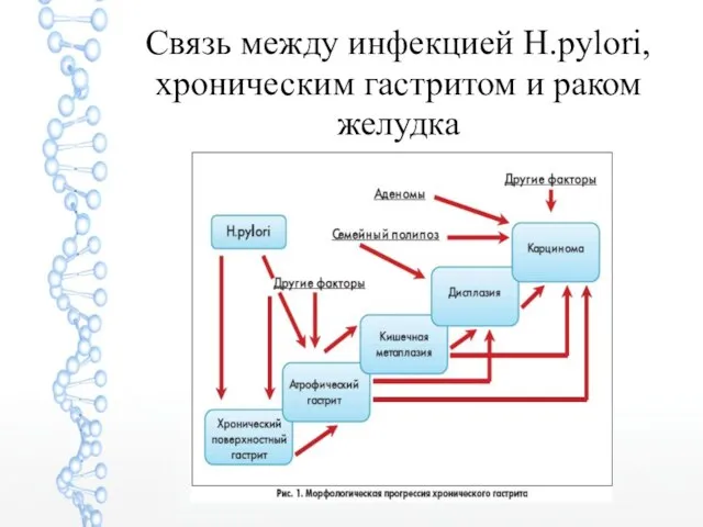 Связь между инфекцией H.pylori, хроническим гастритом и раком желудка