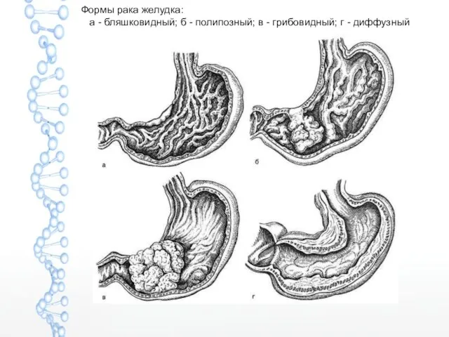 Формы рака желудка: а - бляшковидный; б - полипозный; в - грибовидный; г - диффузный