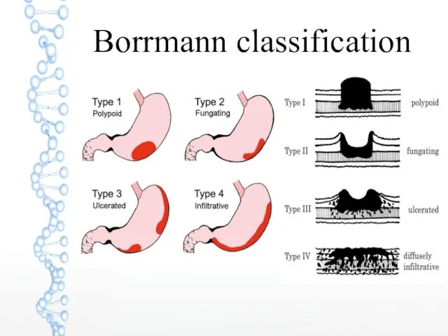 Borrmann classification