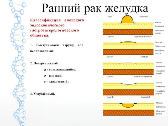 Ранний рак желудка Классификация японского эндоскопического гастроэнтерологического общества: 1. Выступающий наружу,