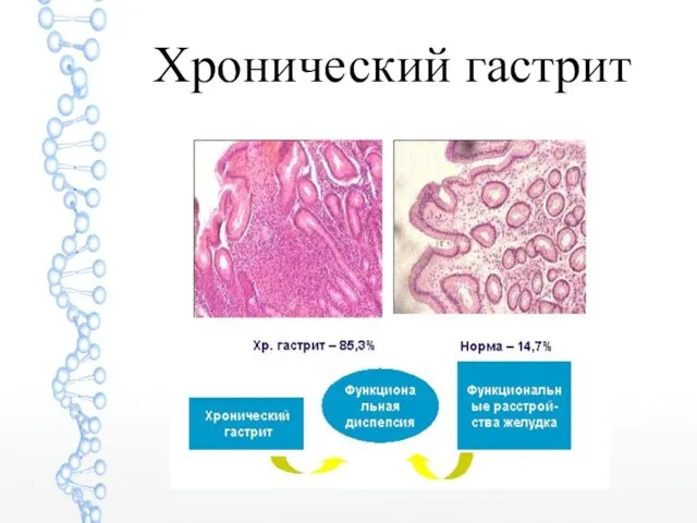 Хронический гастрит