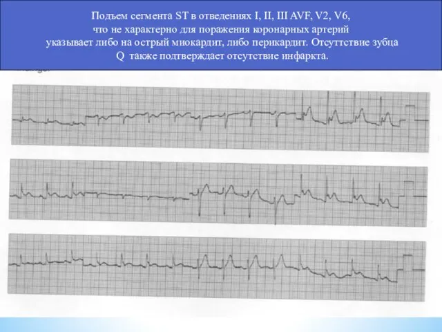 Подъем сегмента ST в отведениях I, II, III AVF, V2, V6,