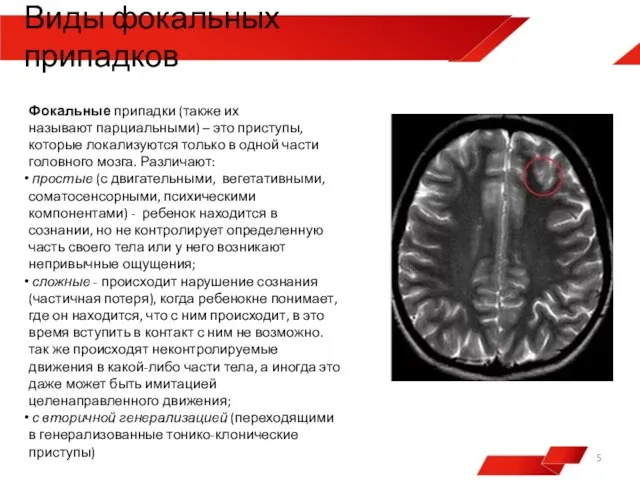 Фокальные припадки (также их называют парциальными) – это приступы, которые локализуются