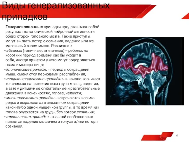 Генерализованные припадки представляют собой результат патологической нейронной активности обеих сторон головного