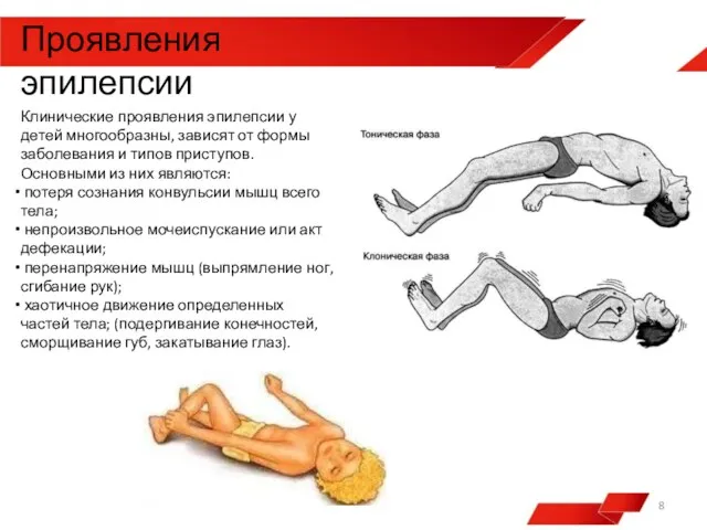 Клинические проявления эпилепсии у детей многообразны, зависят от формы заболевания и