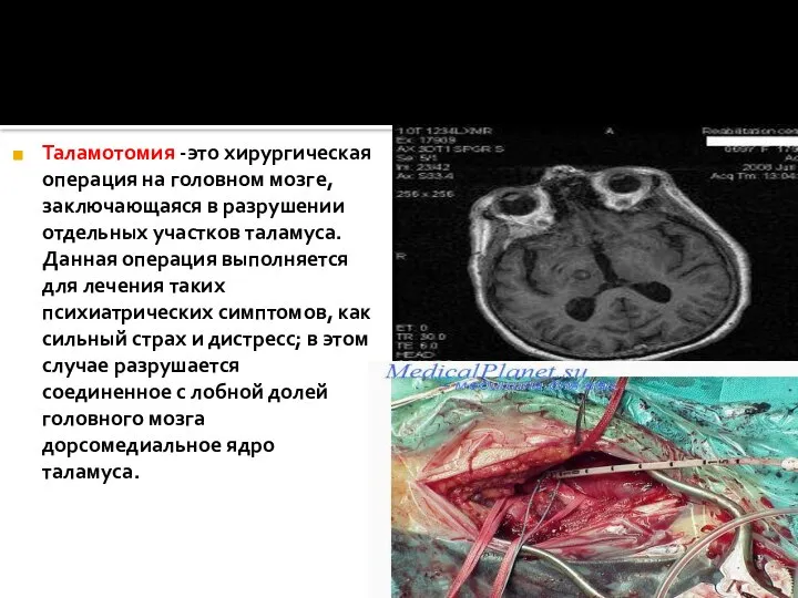 Таламотомия -это хирургическая операция на головном мозге, заключающаяся в разрушении отдельных