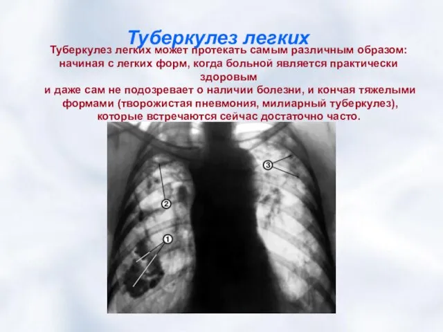 Туберкулез легких Туберкулез легких может протекать самым различным образом: начиная с