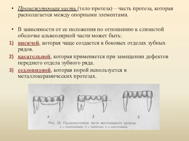 Промежуточная часть (тело протеза) – часть протеза, которая располагается между опорными