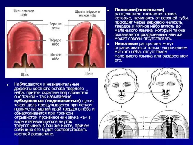 Наблюдаются и незначительные дефекты костного остова твердого нёба, притом скрытые под