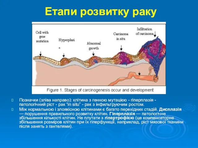 Етапи розвитку раку Позначки (зліва направо): клітина з генною мутацією -