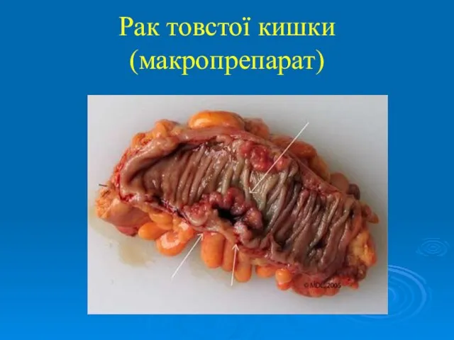 Рак товстої кишки (макропрепарат)