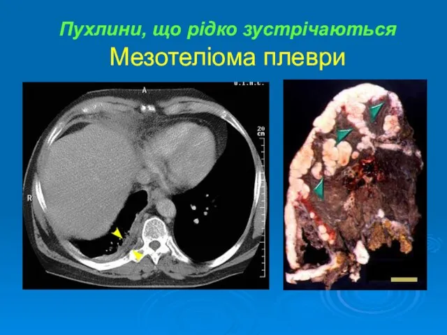 Пухлини, що рідко зустрічаються Мезотеліома плеври