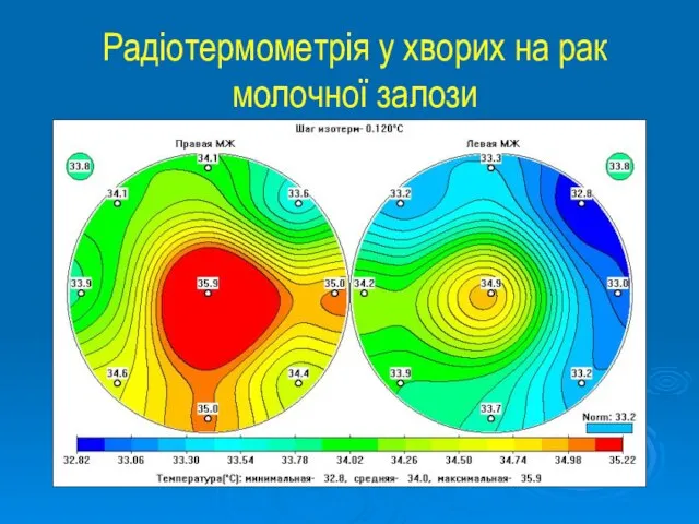 Радіотермометрія у хворих на рак молочної залози