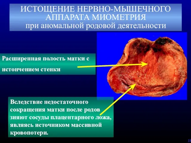 ИСТОЩЕНИЕ НЕРВНО-МЫШЕЧНОГО АППАРАТА МИОМЕТРИЯ при аномальной родовой деятельности Вследствие недостаточного сокращения