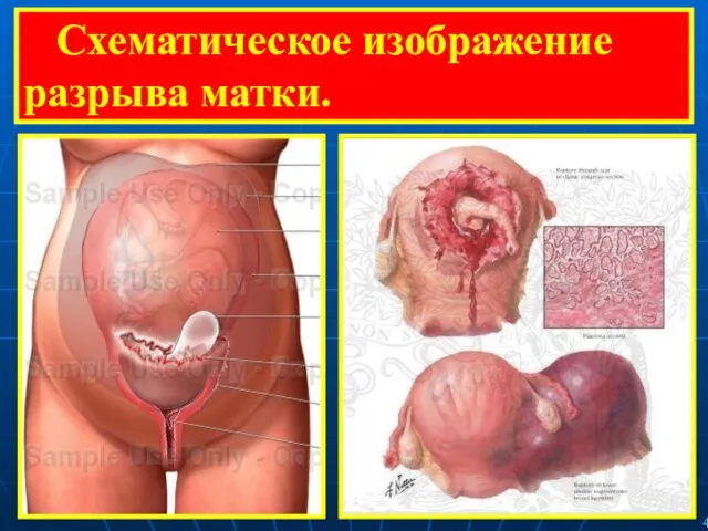 Схематическое изображение разрыва матки.