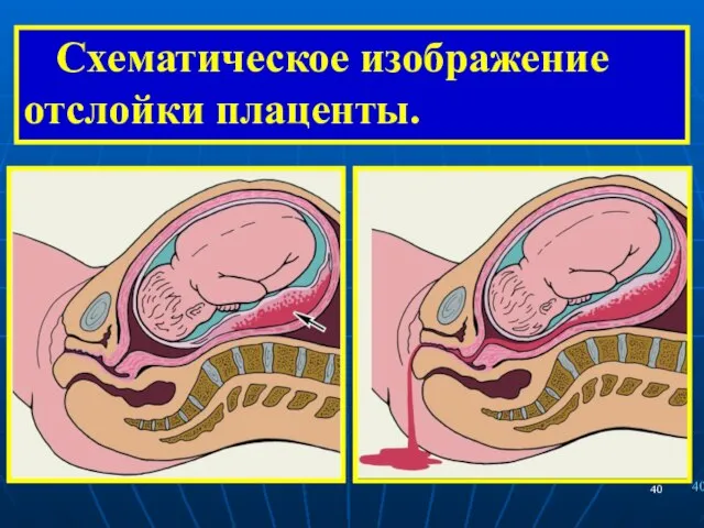 Схематическое изображение отслойки плаценты.