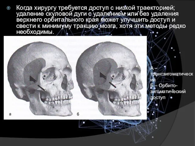 Когда хирургу требуется доступ с низкой траекторией, удаление скуловой дуги с