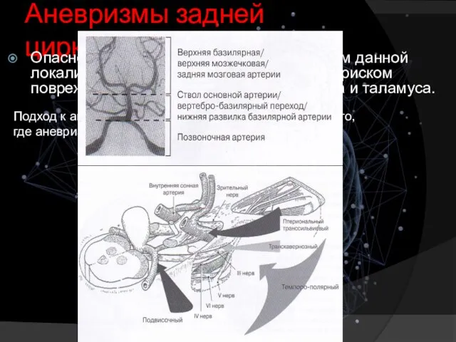 Аневризмы задней циркуляции Опасности оперативного лечения аневризм данной локализации связаны в