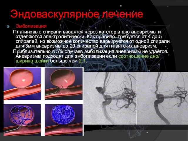 Эндоваскулярное лечение Эмболизация Платиновые спирали вводятся через катетер в дно аневризмы