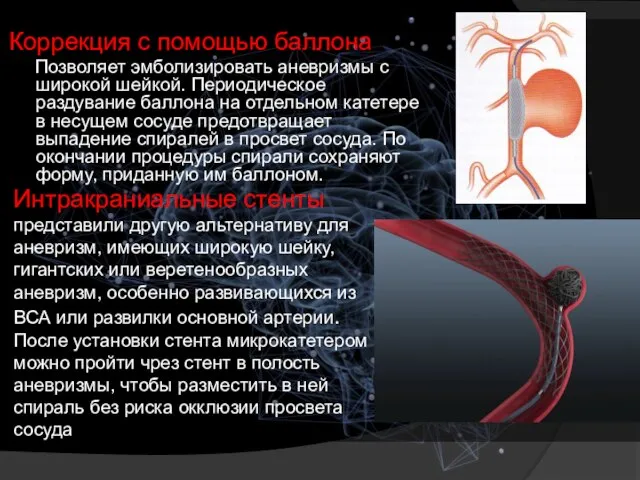 Коррекция с помощью баллона Позволяет эмболизировать аневризмы с широкой шейкой. Периодическое