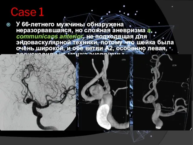 Case 1 У 66-летнего мужчины обнаружена неразорвавшаяся, но сложная аневризма а.