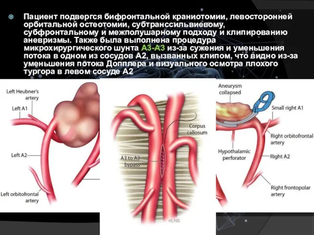 Пациент подвергся бифронтальной краниотомии, левосторонней орбитальной остеотомии, субтранссильвиевому, субфронтальному и межполушарному