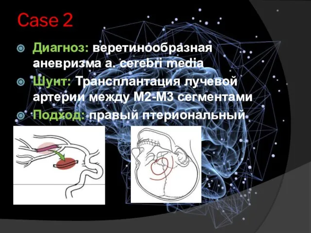 Case 2 Диагноз: веретинообразная аневризма a. cerebri media Шунт: Трансплантация лучевой