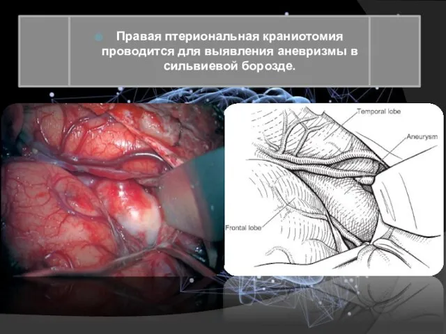 Правая птериональная краниотомия проводится для выявления аневризмы в сильвиевой борозде.