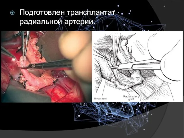 Подготовлен трансплантат радиальной артерии.