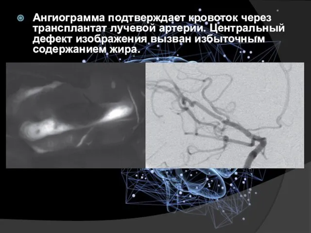 Ангиограмма подтверждает кровоток через трансплантат лучевой артерии. Центральный дефект изображения вызван избыточным содержанием жира.