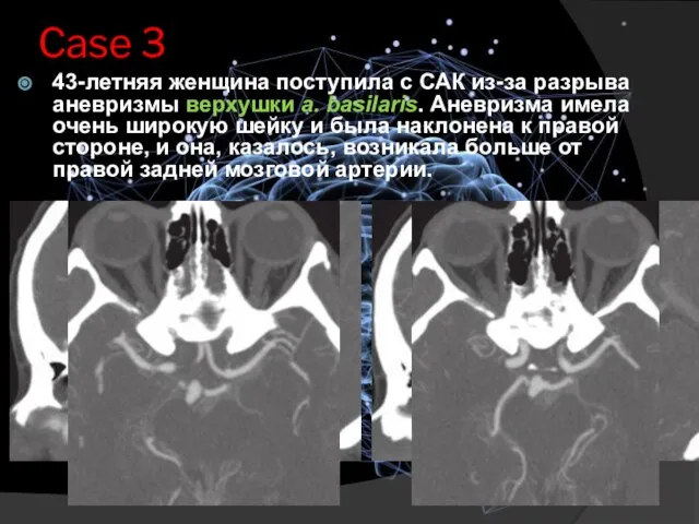 Case 3 43-летняя женщина поступила с САК из-за разрыва аневризмы верхушки