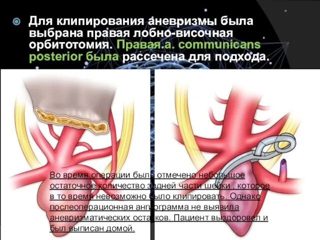 Для клипирования аневризмы была выбрана правая лобно-височная орбитотомия. Правая a. communicans