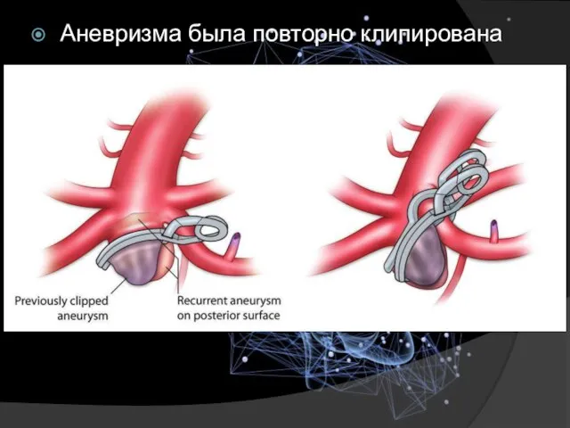 Аневризма была повторно клипирована