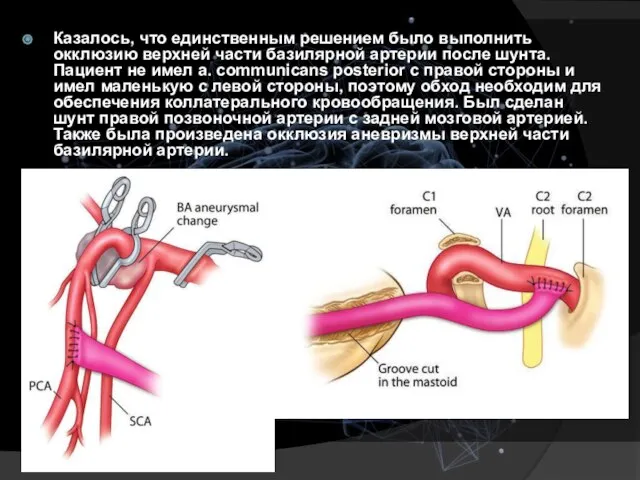 Казалось, что единственным решением было выполнить окклюзию верхней части базилярной артерии