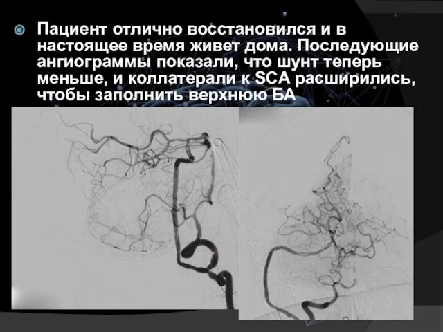 Пациент отлично восстановился и в настоящее время живет дома. Последующие ангиограммы