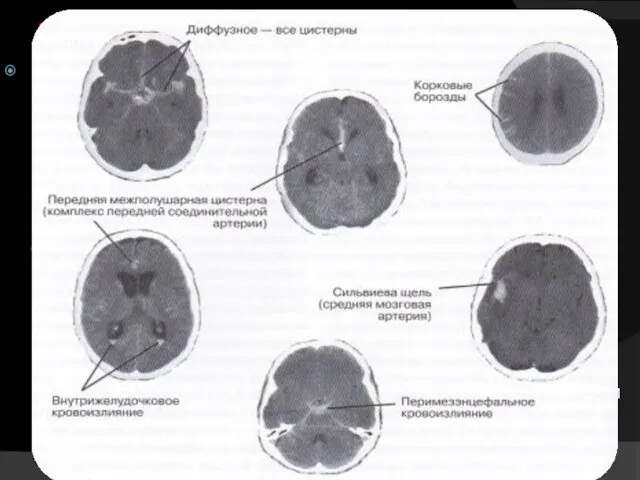 Диагностика Хотя МРТ более чувствительна чем КТ к наличию крови в