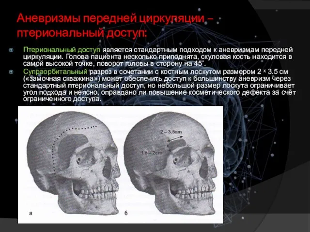 Аневризмы передней циркуляции – птериональный доступ: Птериональный доступ является стандартным подходом