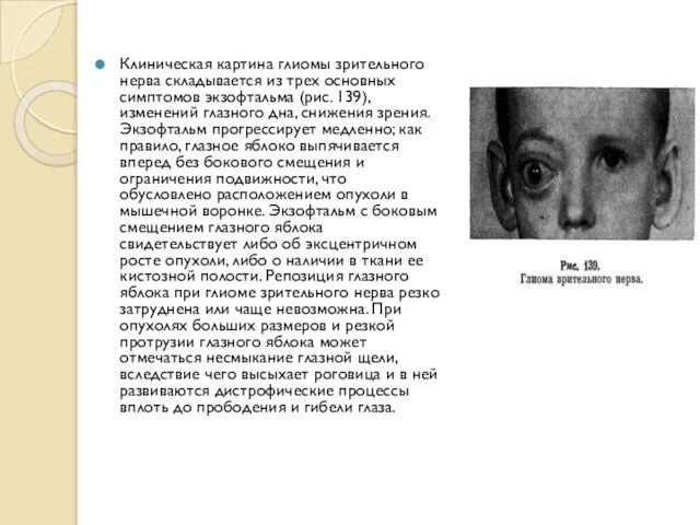 Клиническая картина глиомы зрительного нерва складывается из трех основных симптомов экзофтальма