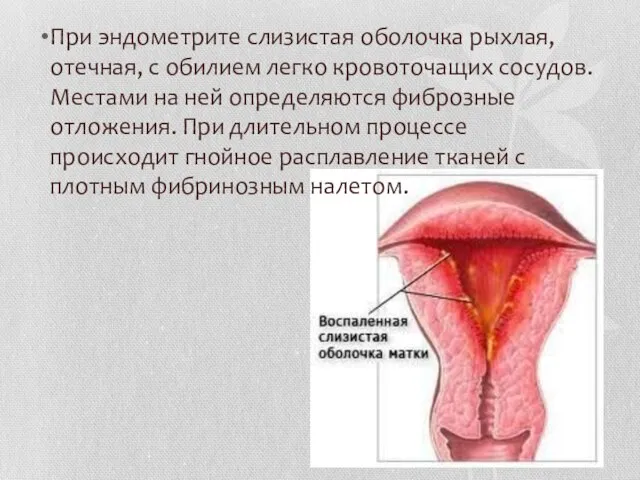 При эндометрите слизистая оболочка рыхлая, отечная, с обилием легко кровоточащих сосудов.