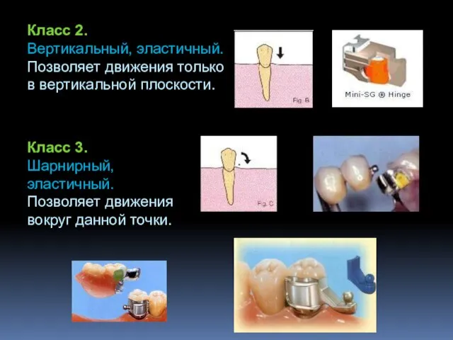 Класс 2. Вертикальный, эластичный. Позволяет движения только в вертикальной плоскости. Класс