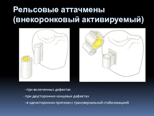 Рельсовые аттачмены (внекоронковый активируемый) - при включенных дефектах при двусторонних концевых