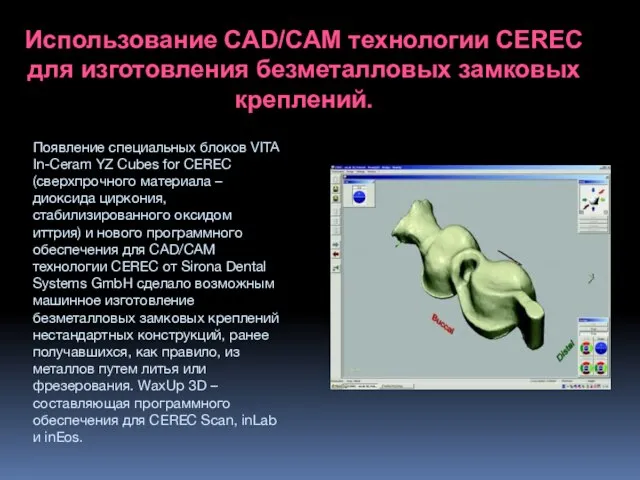 Использование CAD/CAM технологии CEREC для изготовления безметалловых замковых креплений. Появление специальных