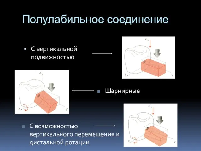 Полулабильное соединение С вертикальной подвижностью Шарнирные С возможностью вертикального перемещения и дистальной ротации