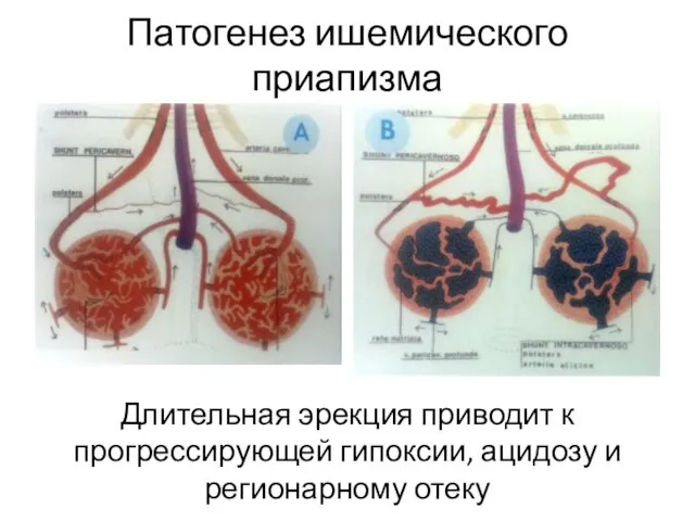 Патогенез ишемического приапизма Длительная эрекция приводит к прогрессирующей гипоксии, ацидозу и регионарному отеку