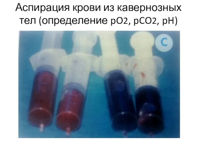 Аспирация крови из кавернозных тел (определение pO2, pCO2, pH)