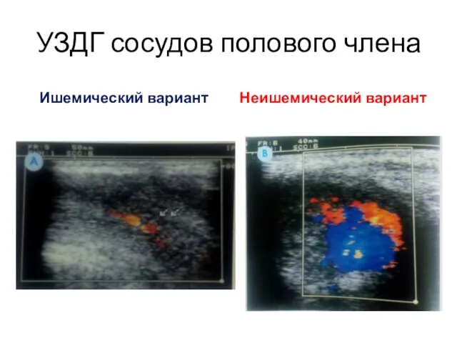 УЗДГ сосудов полового члена Ишемический вариант Неишемический вариант